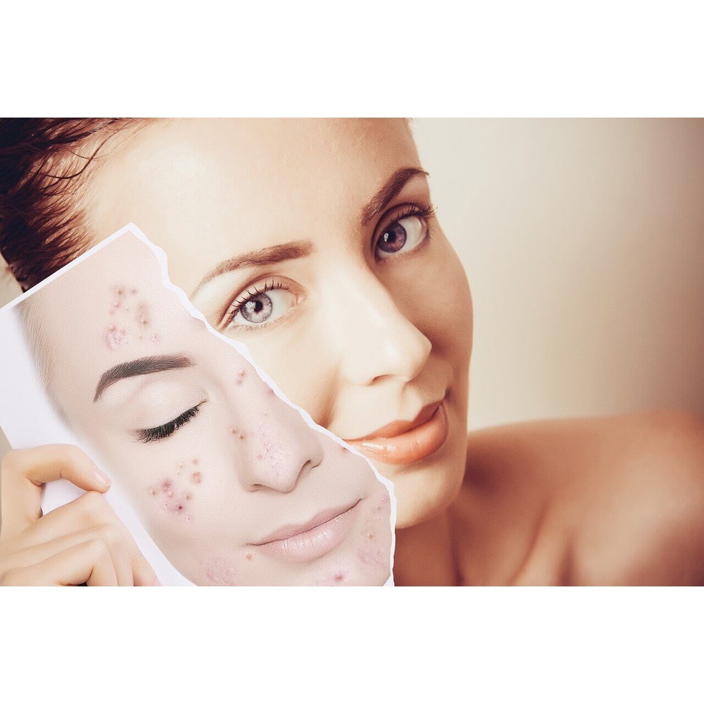 KEM MỜ SẸO, THÂM DA  ANZELA C - 10g