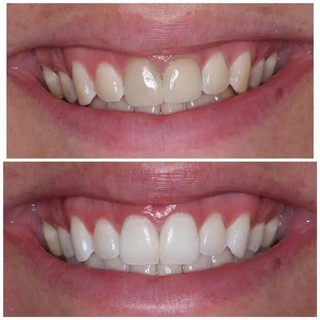 Combo Trắng Răng Eucryl - Răng Trắng, Hết Ố Vàng, Thơm Miệng