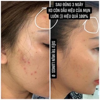 SERUM GIẢM MỤN LUMOS ACNE