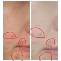 Xịt dưỡng nhả thâm Trà đen Kombucha