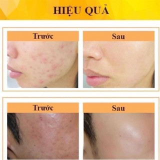 KEM MỤN DERMA FORTE 15G