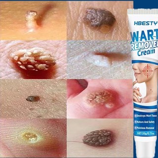 Gel tẩy mụn cóc Tẩy nốt ruồi kem xóa nốt ruồi,mụn cóc,mụn thịt,tàn nhang an toàn và hiệu quả 20g