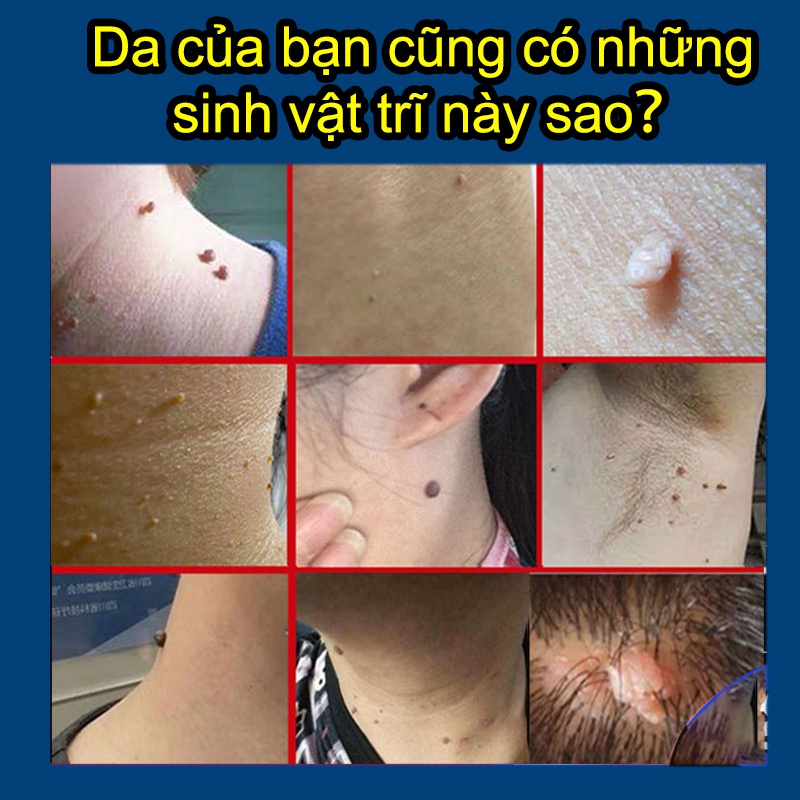 Gel tẩy mụn cóc Tẩy nốt ruồi kem xóa nốt ruồi,mụn cóc,mụn thịt,tàn nhang an toàn và hiệu quả 20g