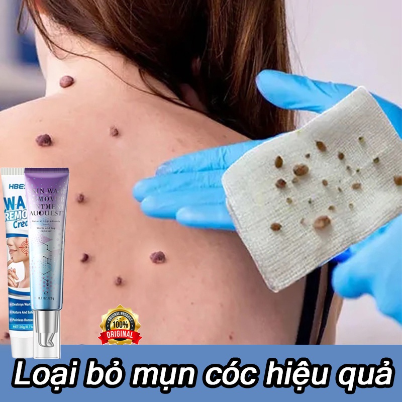Kem loại bỏ mụn cóc loại bỏ nốt ruồi sạch mụn thịt thừa mụn cóc mụn nốt duồi và các mụn li ti quanh mắt 20g