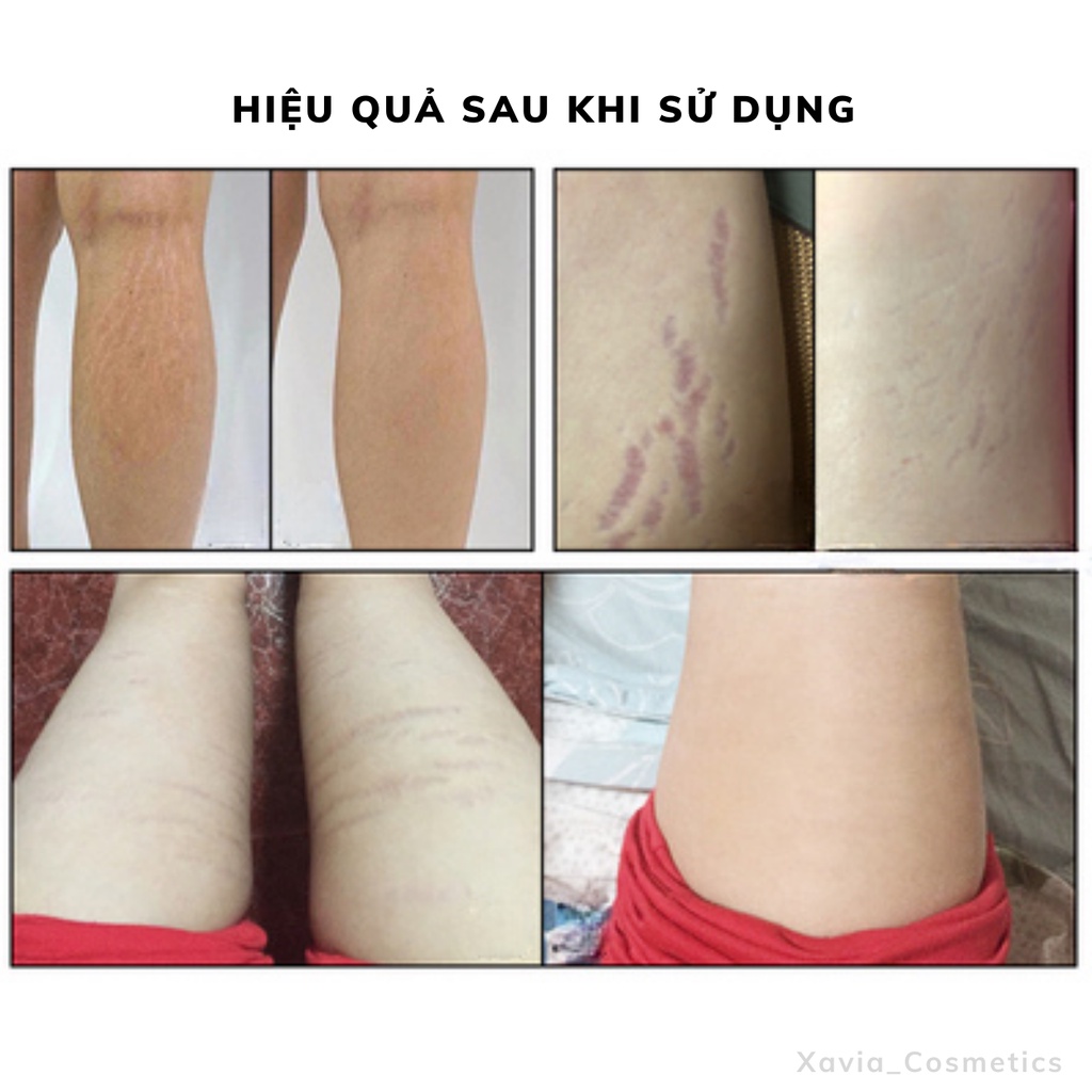 Tinh dầu rạn da oliu XROLAND - Tinh dầu oliu làm mờ rạn da, tái tạo làn da mịn màng, săn chắc