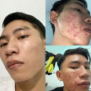 combo 2 lọ serum mụn dr skinacnes ( tặng hũ gel lột mụn)