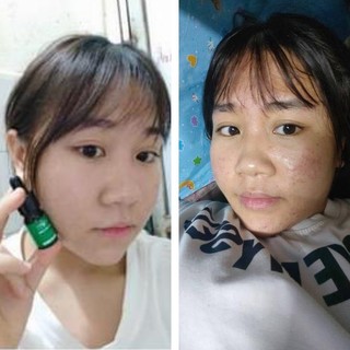 combo 2 lọ serum mụn dr skinacnes ( tặng hũ gel lột mụn)