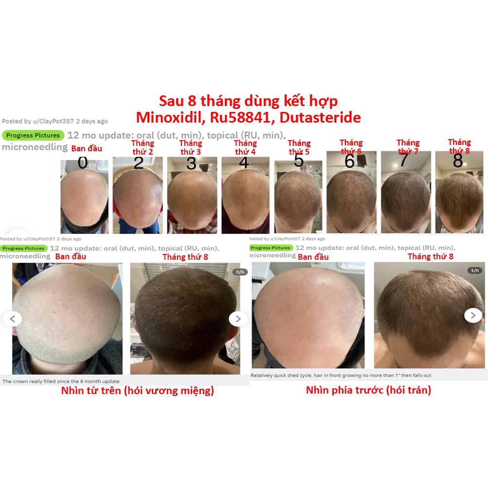 Bột RU58841 nguyên liệu mỹ phẩm tóc bôi kèm minoxidil, giúp tăng hiệu quả ngăn rụng hói