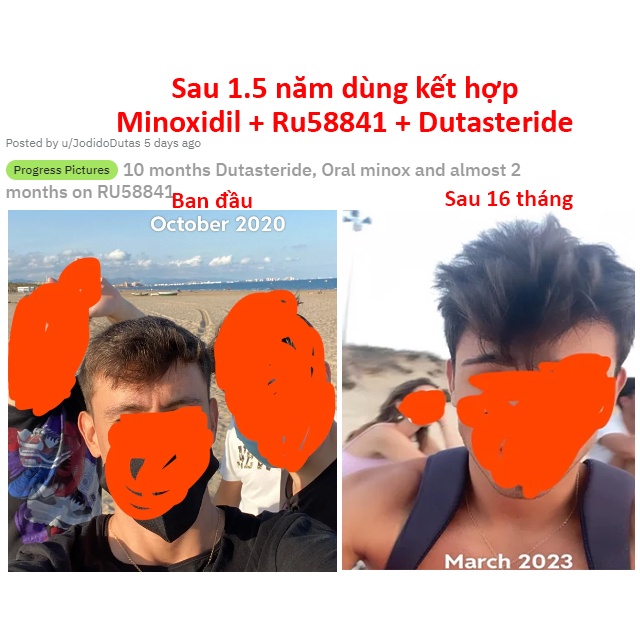 Bột RU58841 nguyên liệu mỹ phẩm tóc bôi kèm minoxidil, giúp tăng hiệu quả ngăn rụng hói