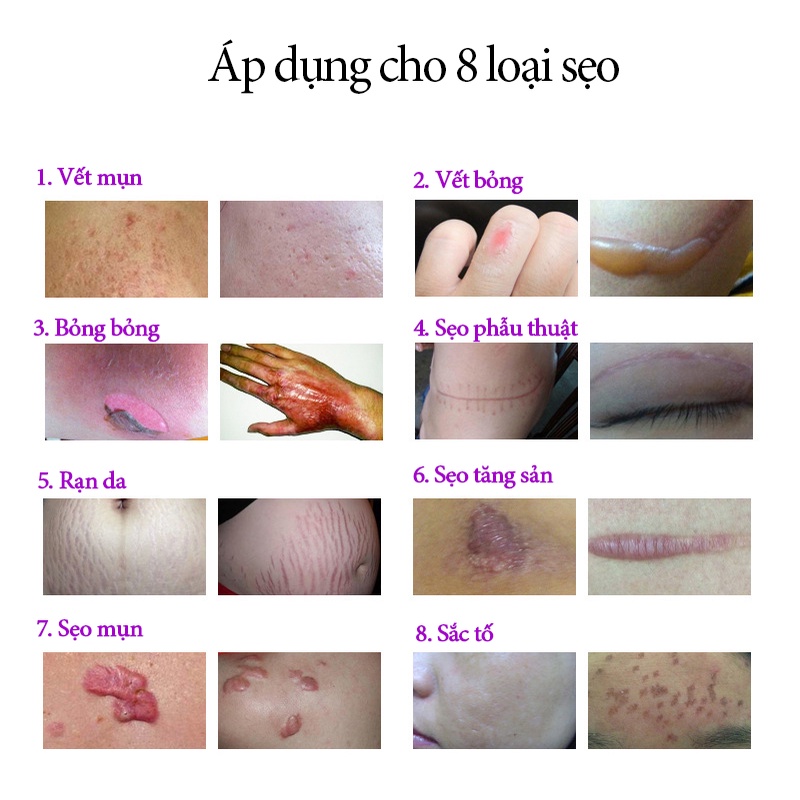 Kem Sẹo Kem xóa Sẹo dermatix Sửa chữa sẹo Kem tẩy tế sẹo Sẹo tăng sinh Vết sẹo phẫu thuật Chuyên