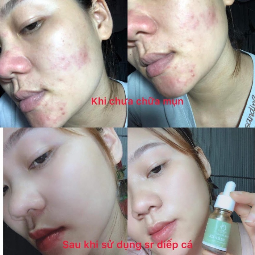 SERUM GIẢM MỤN SAU 7 NGÀY - SERUM DIẾP CÁ IGREEN