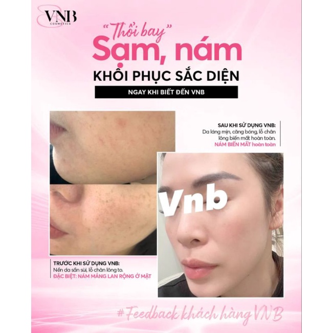 Serum peel mạnh vnb chính hãng