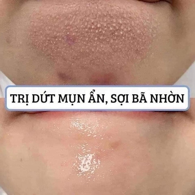 MINISIZE dung dịch tẩy da chết, sạch mụn ẩn, sợi bã nhờn, mụn đầu đen BHA 30ml