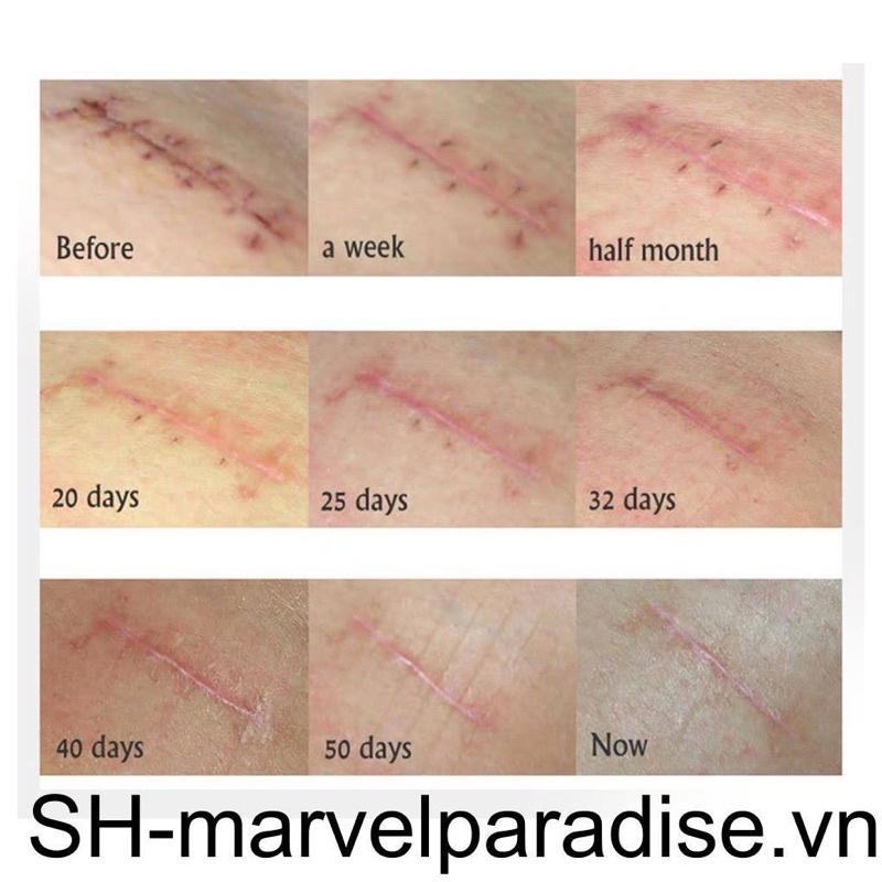 Tinh chất Sẹo blurred scar cho mọi loại sẹo ,kể cả sẹo lâu năm