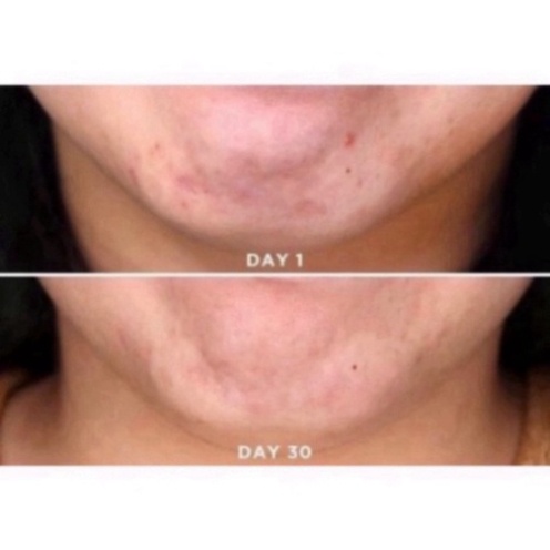 Serum Tinh Chất Giảm thâm giảm mụn The Ordinary Niacinamide 10% Zinc 1% 30ml,60ml đủ Bill chính hãng, Senya Cosmetics