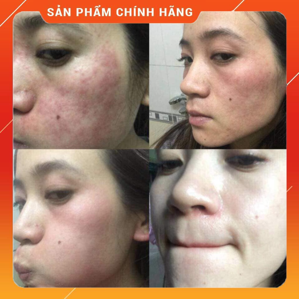 Tinh chất mụn ACNE SKIN SERUM Chamomileskill MẪU MỚI