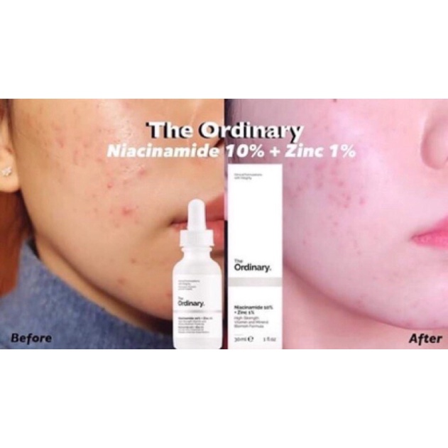 Serum The Ordinary AHA 30% + BHA 2% Peeling solution