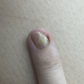 phục hồi móng nấm