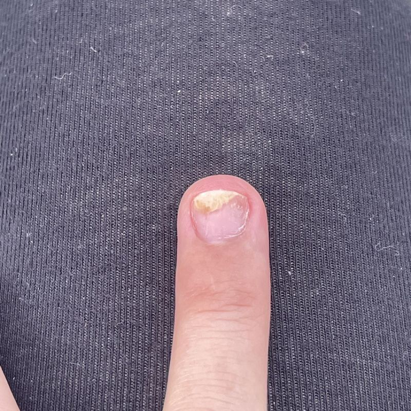 phục hồi móng nấm