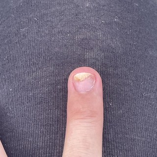 phục hồi móng nấm