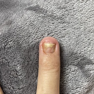 phục hồi móng nấm