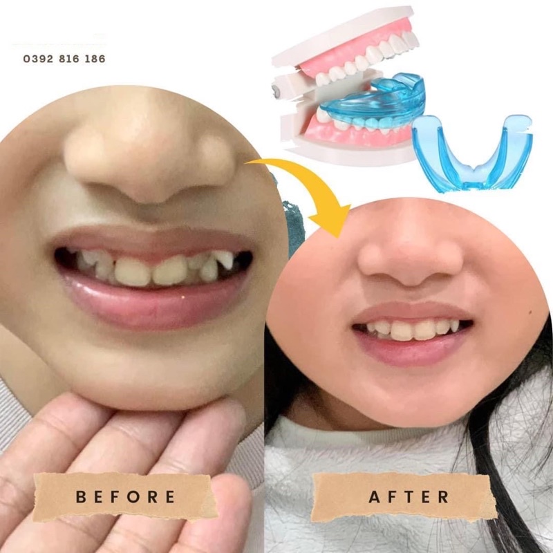 Niềng răng cho bé tại nhà - Niềng răng Silicone Trainer của Mỹ An Toàn hiệu quả cho bé từ 5-12 tuổi