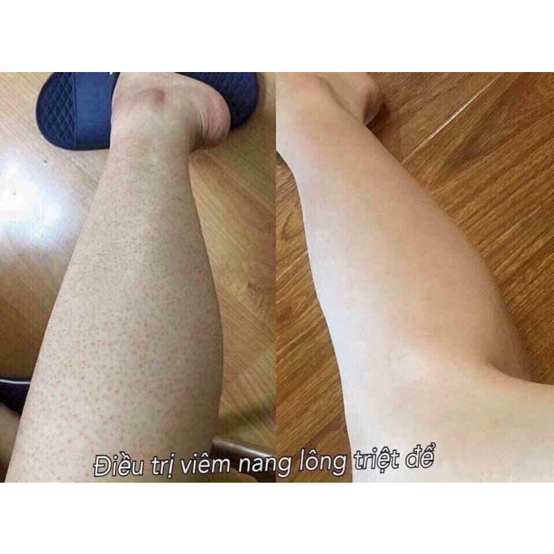 KELA LOTION vıêm LỖ châŋ LÔNG THÁI LAN 60ML ..