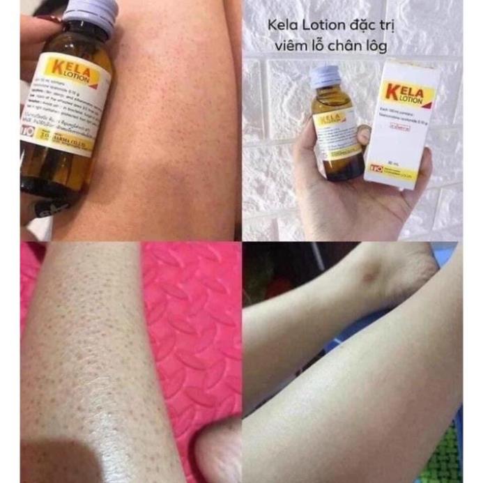 KELA LOTION vıêm LỖ châŋ LÔNG THÁI LAN 60ML ..