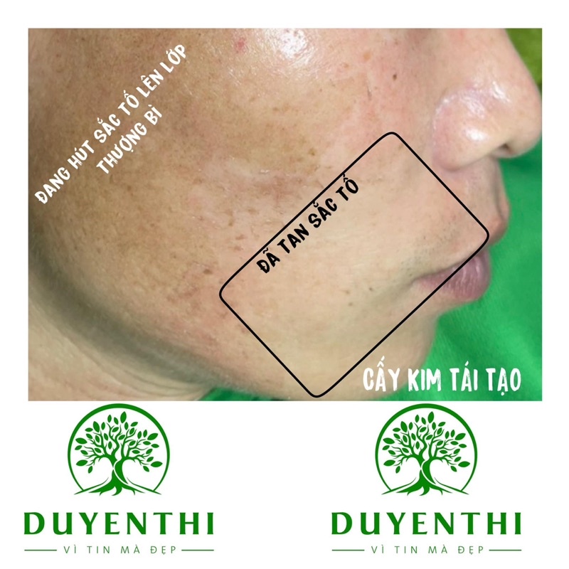 Bạch Linh 12 Cấy Kim Duyên Thị Nanotech