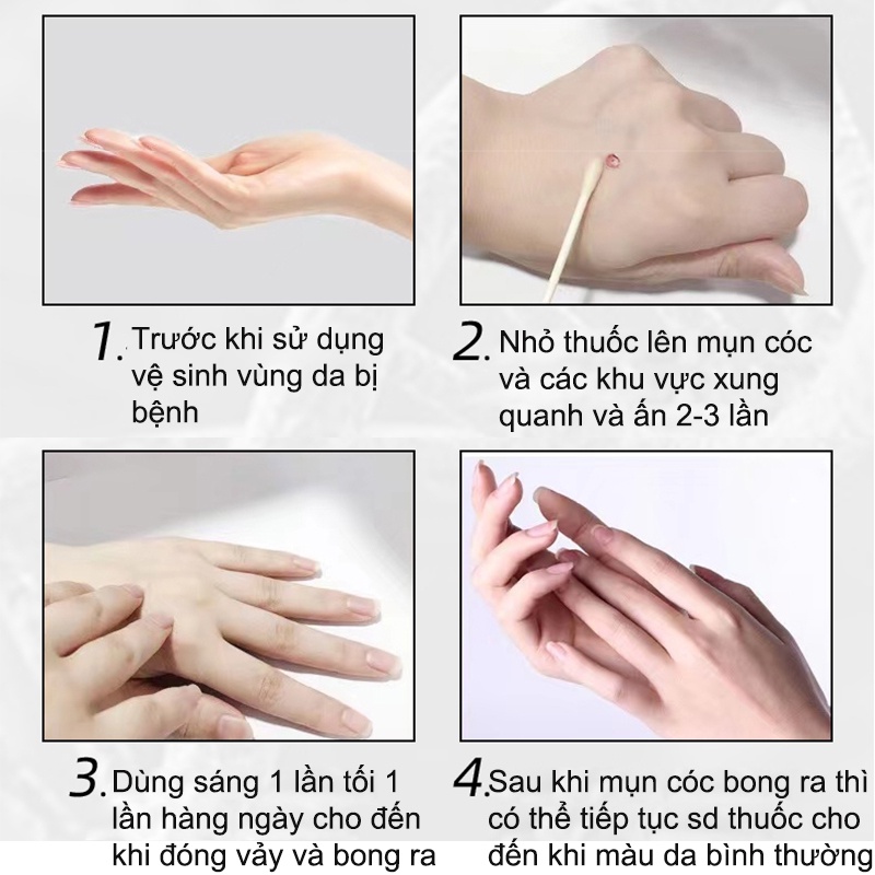 Kem Tẩy Mụn Cóc kem tẩy nốt ruồi mụn cóc 7 ngày loại bỏ mụn cóc nhanh chóng Loại bỏ mụn cóc an toàn và không đau 10ml
