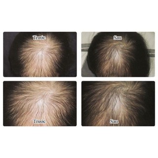Xịt tóc Minoxidil Bailleul 2% 5% 60ml