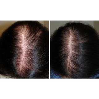 Xịt tóc Minoxidil Bailleul 2% 5% 60ml