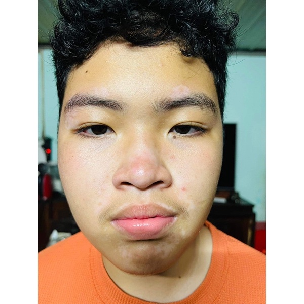 Thảo dược bôi bạch biến