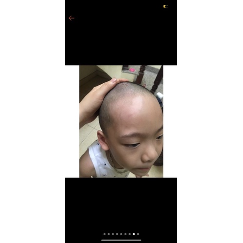 Đèn PHILIP UVB 311 chiếu bạch biến,vảy nến ,viêm da cơ địa….