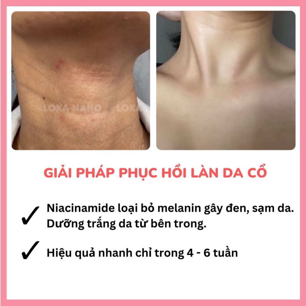 [MUA 3 TẶNG QUÀ]Combo 3 Hộp - Kem dưỡng cổ Loka Nano 50ml Làm trắng dưỡng ẩm săn chắc làn da