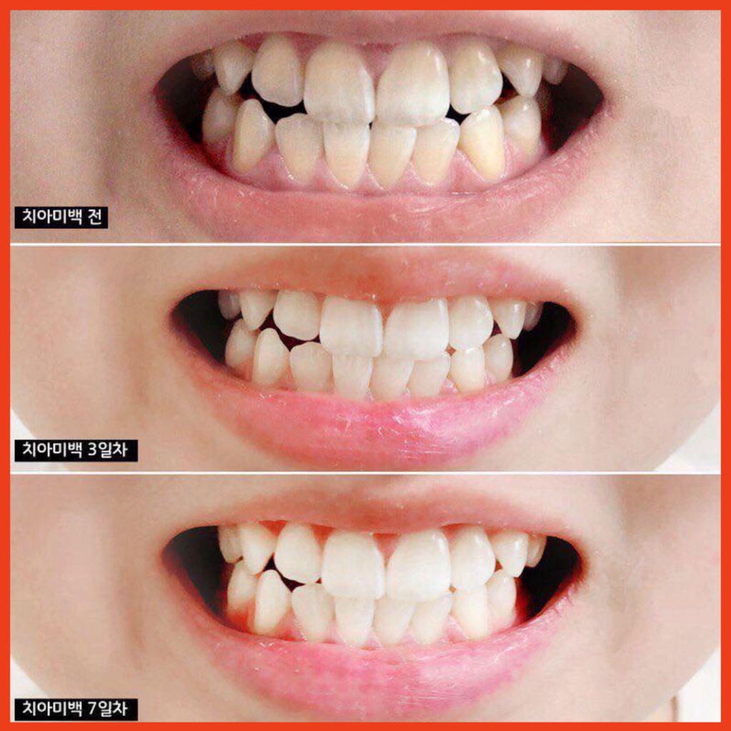 KEM ĐÁNH RĂNG MEDIAN 93% HÀN QUỐC