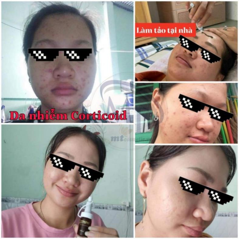 Tảo biển trứng cá tuyết Derma peel+ - TÁI TẠO MÔ DA - KHÔNG GÂY BONG DA - CHUẨN SPA