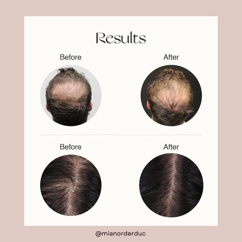 Serum mọc tóc M2 BEAUTÉ hair activating serum 120ml - hàng nội địa Đức