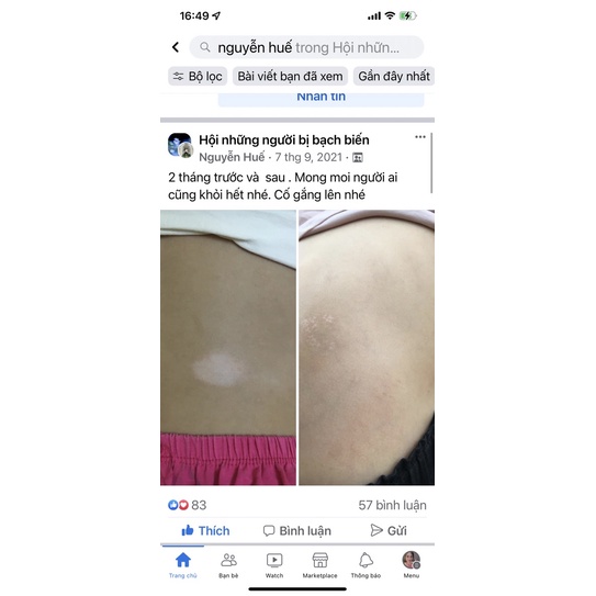 Đèn PHILIP UVB 311 chiếu bạch biến,vảy nến ,viêm da cơ địa….