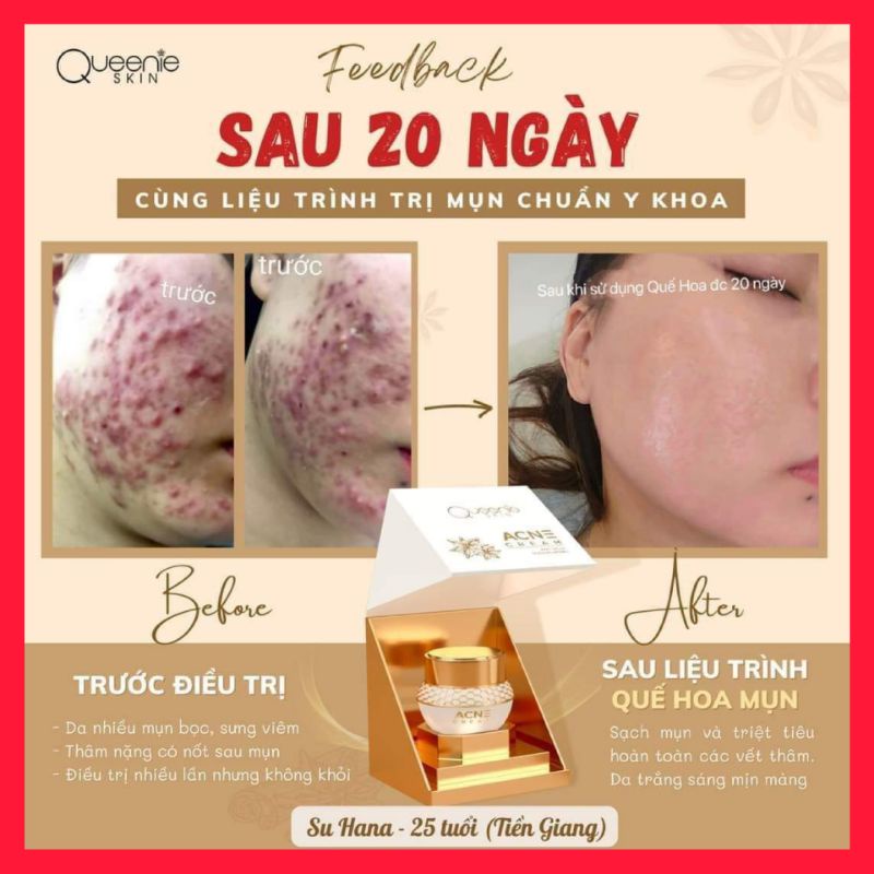 Mụn Hoa Quế chính hãng
