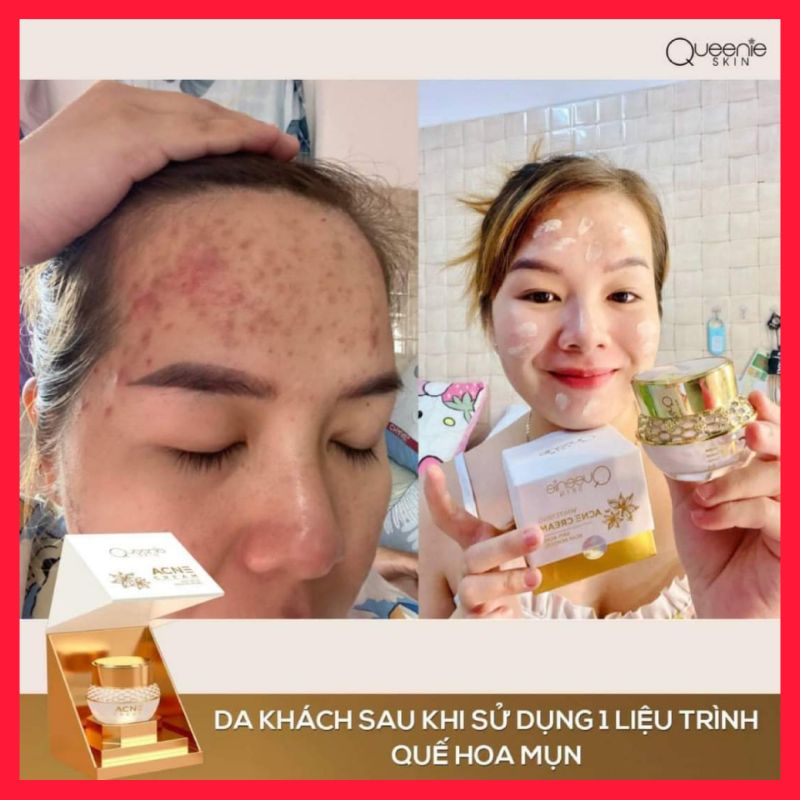 Mụn Hoa Quế chính hãng