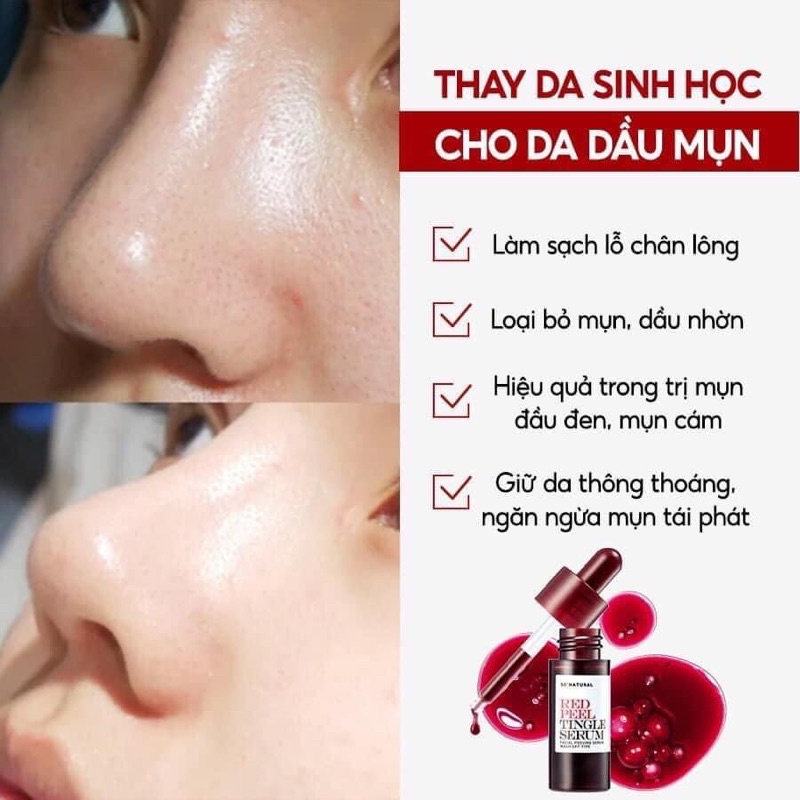 Tinh chất Red Peel Tingle Serum So Natural tẩy tế bào chết tái tạo da thay da sinh học không bong tróc