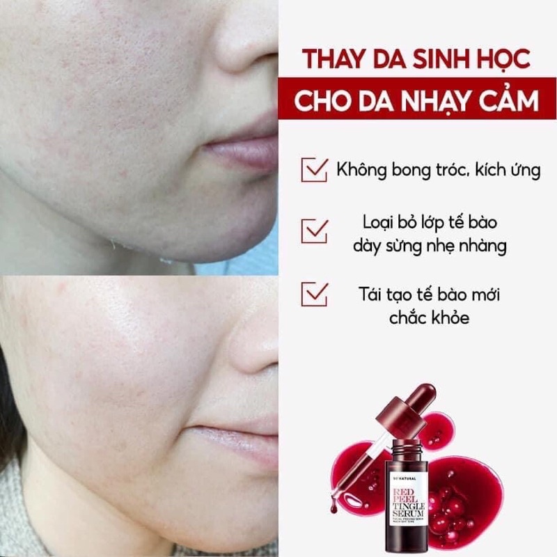 Tinh chất Red Peel Tingle Serum So Natural tẩy tế bào chết tái tạo da thay da sinh học không bong tróc