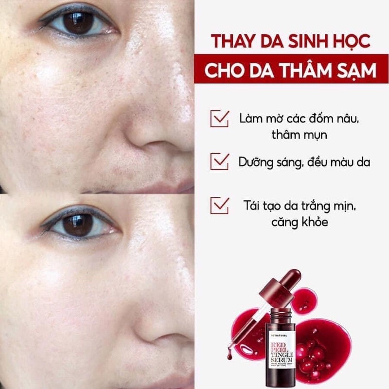 Tinh chất Red Peel Tingle Serum So Natural tẩy tế bào chết tái tạo da thay da sinh học không bong tróc