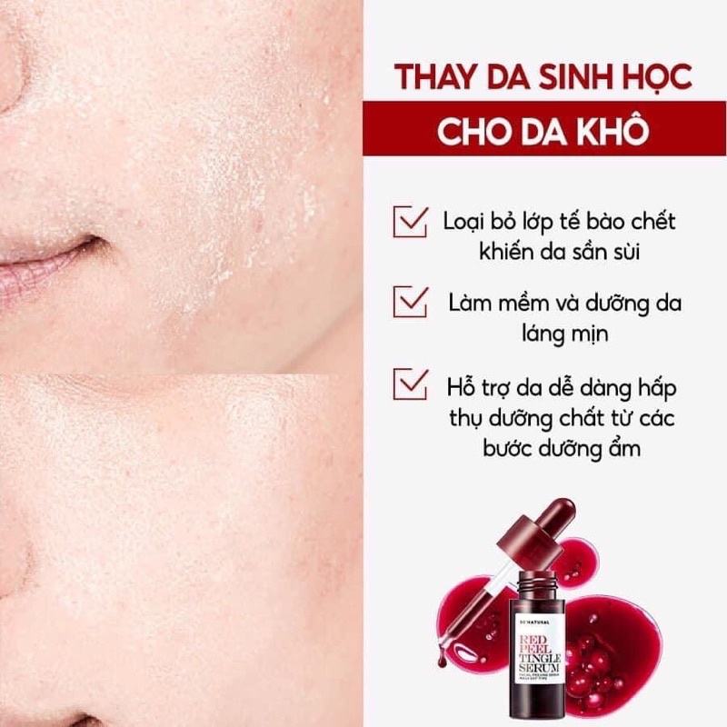 Tinh chất Red Peel Tingle Serum So Natural tẩy tế bào chết tái tạo da thay da sinh học không bong tróc