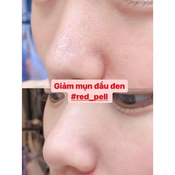 Tinh chất Red Peel Tingle Serum So Natural tẩy tế bào chết tái tạo da thay da sinh học không bong tróc