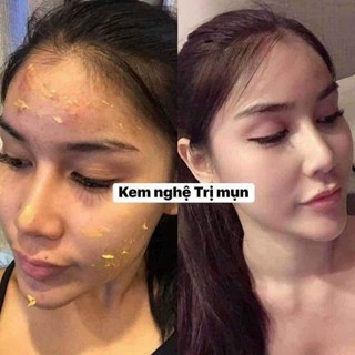 Kem Nghệ HERBAL TURMERIC CREAM