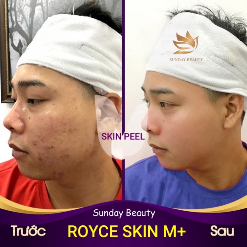 Peel da ROYCE SKIN M+ bóc tách nám tàn nhang sẹo rỗ lõm mụn thâm.. .
