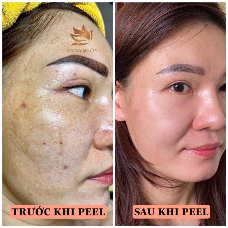 Tinh chất peel da ROYCE SKIN M+ bóc tách nám tàn nhang sẹo rỗ lõm mụn thâm .