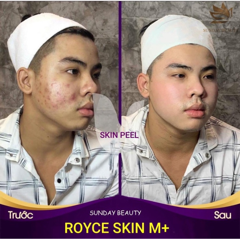 Peel da ROYCE SKIN M+ tinh chất thay da bóc tách sẹo rỗ lõm nám tàn nhang mụn thâm .